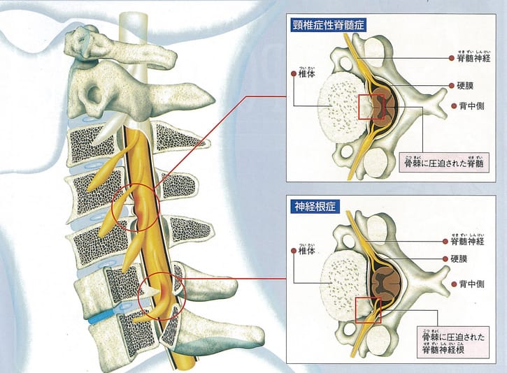 変形性頸椎症について