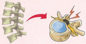 脊柱関連（骨柱、椎間板性、椎間関節症、筋・筋膜症）