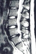 MRI検査（T2強調画像）