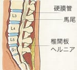 MRI検査（T2強調画像）