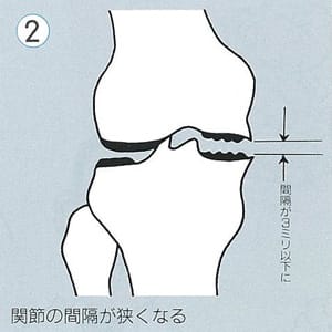 ２．関節の間隔が狭くなる