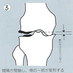 ３．間隔が閉鎖し、骨の一部が変形する